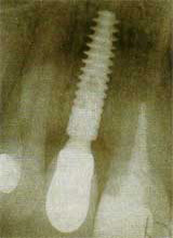 Implantat, Röntgenbild Verankerung